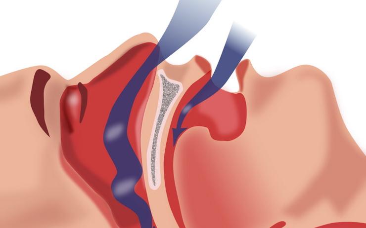 Obstruction_ventilation_apnée_sommeil